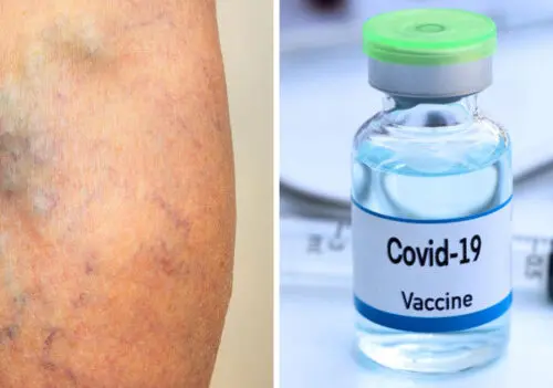 Vacunas contra el covid, ¿podrían reducir el riesgo de coágulos y daños al corazón?