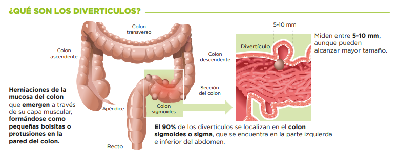 divertículos