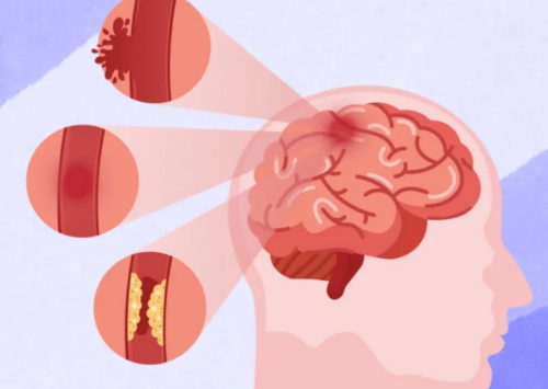 Las primeras 4.5 horas del Accidente Cerebral Vascular son vitales